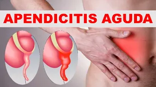 🔴 APENDICITIS AGUDA | SIGNOS Y SÍNTOMAS, CAUSAS, FISIOPATOLOGÍA, DIAGNÓSTICO Y TRATAMIENTO