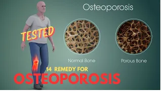 14 POSSIBLE REMEDIES FOR OSTEOPOROSIS