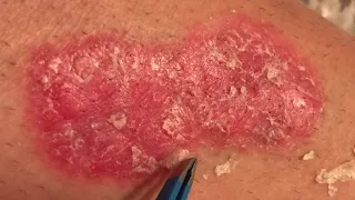 Psoriasis scab peel #4