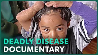 Meningitis: Search For A Cure (Medical Documentary) | Real Stories