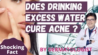 Does Drinking Excess Water Cure Acne ? Kya Jyada Paani Peene Se Pimple Theek Ho Jate hai ?