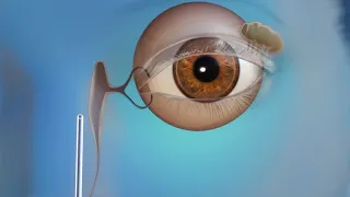 US Ophthalmic Oculoplastics Endoscopic DCR