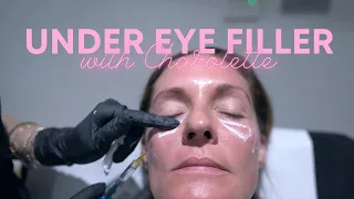 Under Eye Filler Treatment with Dr Nina Bal 💕 Under Eyes Circles Treated with Dermal Filler