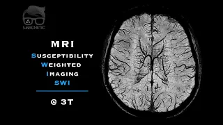 MRI Susceptibility Weighted Imaging (SWI) @ 3T