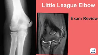 Little League Elbow Exam Review - Christopher S. Ahmad, MD