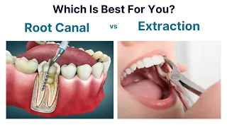 Root Canal Treatment or Tooth Extraction: A Guide To Deciding What's Best For You
