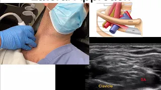 Introduction to Neuroanatomy of the Neck with POCUS