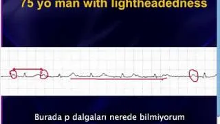 Mattu EKG Vakası -- Her AF AF Değildir -- 5 Ağustos 2013 (Türkçe Altyazılı)