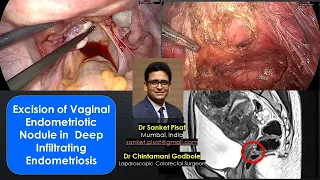 Laparoscopic Deep Endometriotic Nodule Excision | With Voiceover