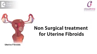 Can Fibroid be removed without surgery? - Dr. Nikhil D Datar of Cloudnine Hospitals| Doctors' Circle