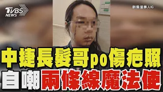 中捷長髮哥po傷疤照 自嘲「兩條線魔法使」｜TVBS新聞 @TVBSNEWS01