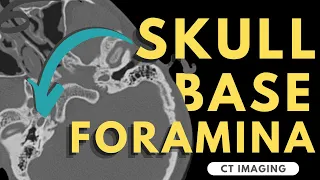 Skull Base Foramina | Radiology anatomy part 1 prep | CT imaging of skull base