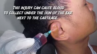 Draining of Massive Ear Hematoma (Cauliflower Ear)