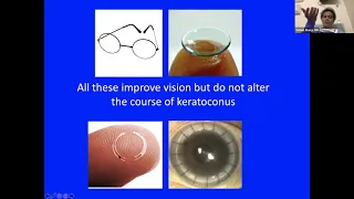 Sight + Sound Bites: Keratoconus: Current and Future Advancements in Treatment