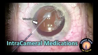IntraCameral Medications during Cataract Surgery