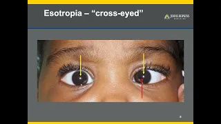 Strabismus | A Patient Guide to Misalignments of the Eyes