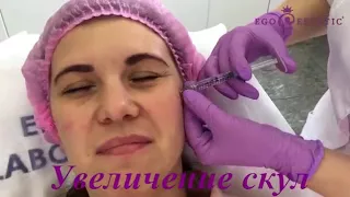 Увеличение скул