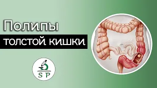 Полипы толстой кишки | Частная патология