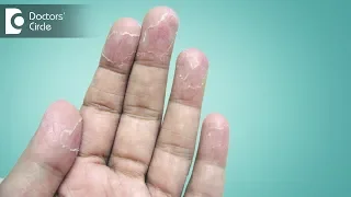Ways to manage peeling of skin from hands - Dr. Sudheendra Udbalker