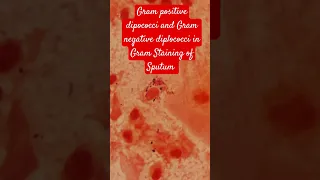 Gram positive dipococci and Gram Negative diplococci bacteria in Gram Staining of Sputum