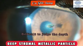 #88 Anterior segment OCT assisted deep corneal foreign body removal on slit-lamp #DrPrateekJain