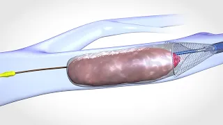 Blood Clot Removal Device - Medical & Scientific Video Production