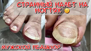 Men's pedicure / Strange plaque on the nails