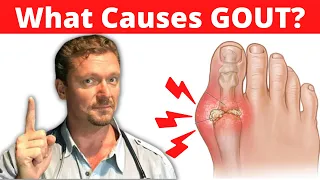 What Causes GOUT? (Meat Doesn't Cause Gout) 2024