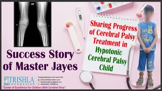 Sharing Progress of Cerebral Palsy Treatment in Hypotonic Cerebral Palsy Child | Trishla Foundation