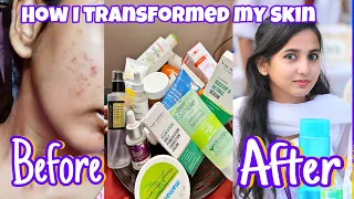 My Skincare Journey - What mistakes I made & How I transformed my Skin | Tamil