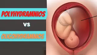 Oligohydramnios vs Polyhydramnios