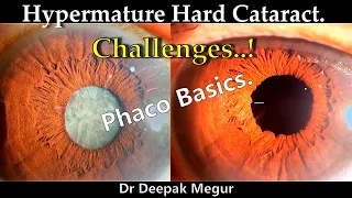 Principle to follow during Phacoemulsification in Hard Cataract - Phaco Basics - Dr Deepak Megur
