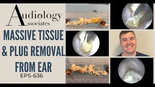 MASSIVE TISSUE & EAR WAX PLUG REMOVAL FROM EAR - EP636