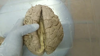 Corpus callosum