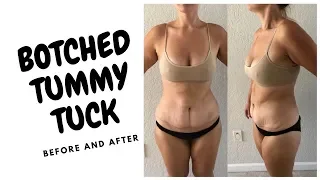 My Tummy Tuck Nightmare - I Was Botched