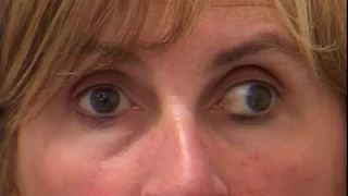 Exotropia en adulto. Los ojos se desvían hacia afuera