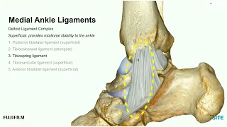 Webinar: Using Ultrasound to Evaluate the Medial Ankle