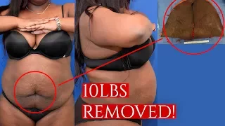 Removing 10lbs Of Skin | Dr. Barretts Tummy Tuck