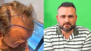 Haartransplantation: Erwartungen vs  Realität nach 8 Monaten