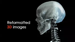 Imaging of Maxillofacial trauma  Prof Dr  Mamdouh Mahfouz In Arabic