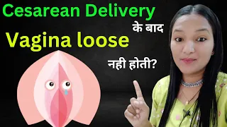 Kiya Cesarean Delivery ke baad Vagina Loose nahi hoti? C Section Delivery