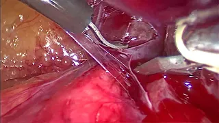 ЛС Резекция без пережатия почечной артерии