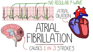 Atrial Fibrillation Made Easy (Complete Overview)