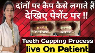 दांतो पे कैप कैसे लगाया जाता है देखे पेशंट पर |Teeth Capping Process On Patient |Teeth Cap Fitting