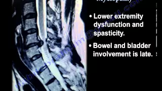 Cervical Spine Myelopathy - Everything You Need To Know - Dr. Nabil Ebraheim