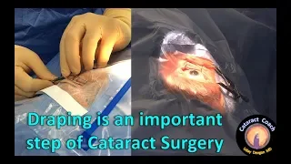 Draping is an Important Step of Cataract Surgery