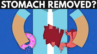 What Happens If Your Stomach Gets Removed?
