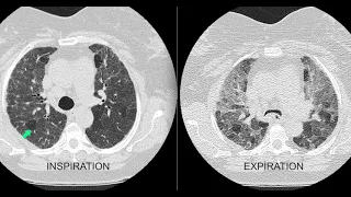 Air trapping on the chest x-ray and CT scan