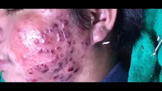 WOW big blackheads on face - remove big blackheads - acne scars 2019