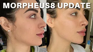 INMODE MORPHEUS8 RESULTS UPDATE (2/3 TREATMENTS IN)